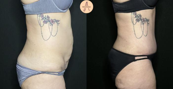 Before & After Tummy Tuck Case 232 Left Side View in San Antonio, Texas