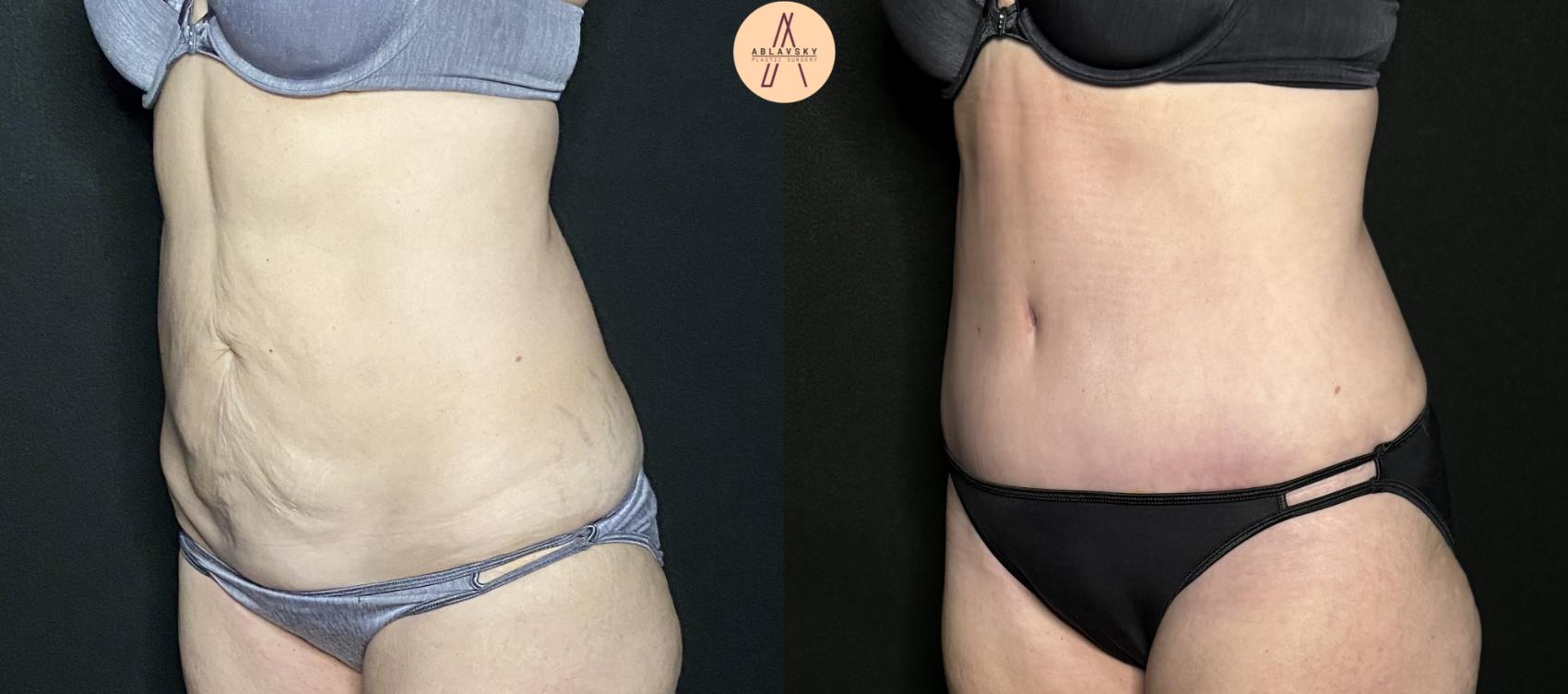 Before & After Liposuction Case 232 Right Oblique View in San Antonio, Texas