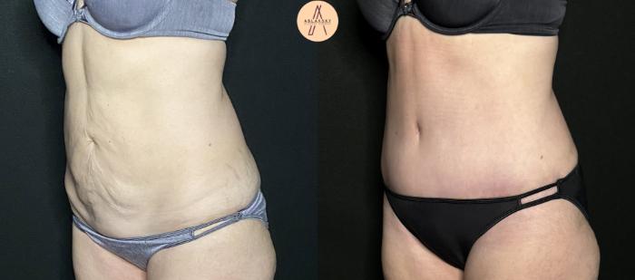 Before & After Tummy Tuck Case 232 Right Oblique View in San Antonio, Texas