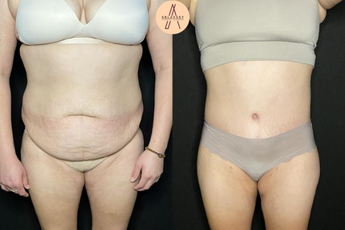 Before & After Tummy Tuck Case 235 Front View in San Antonio, Texas