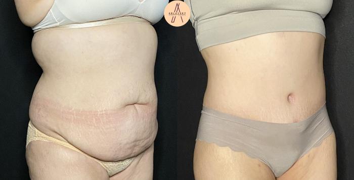 Before & After Tummy Tuck Case 235 Left Oblique View in San Antonio, Texas