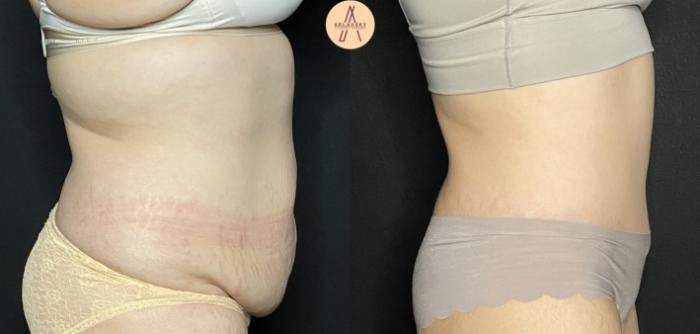 Before & After Tummy Tuck Case 235 Left Side View in San Antonio, Texas