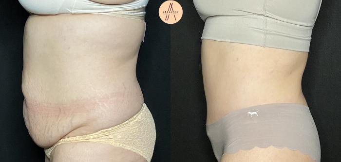 Before & After Tummy Tuck Case 235 Right Side View in San Antonio, Texas