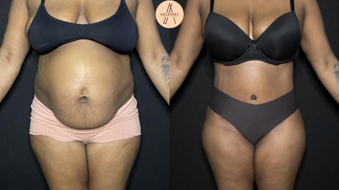 Before & After Tummy Tuck Case 236 Forward View in San Antonio, Texas