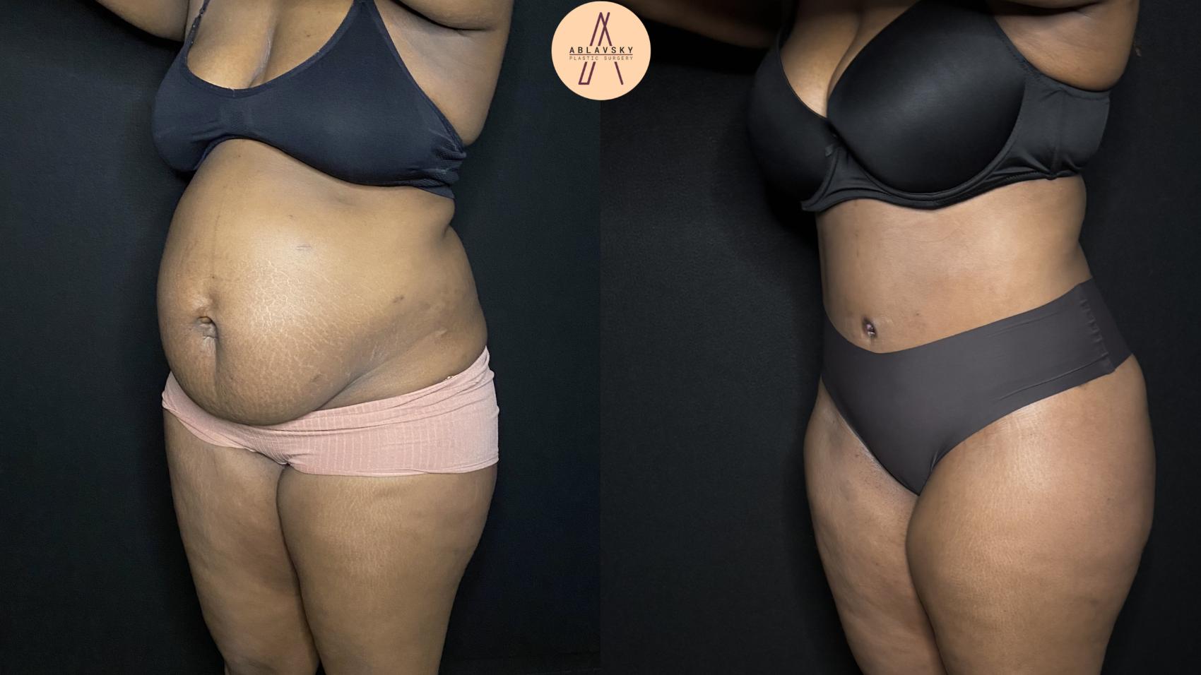 Before & After Tummy Tuck Case 236 Left Oblique View in San Antonio, Texas