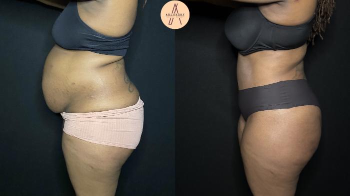 Before & After Liposuction Case 236 Left Side View in San Antonio, Texas