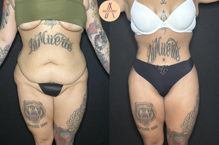 Before & After Tummy Tuck Case 240 Front View in San Antonio, Texas