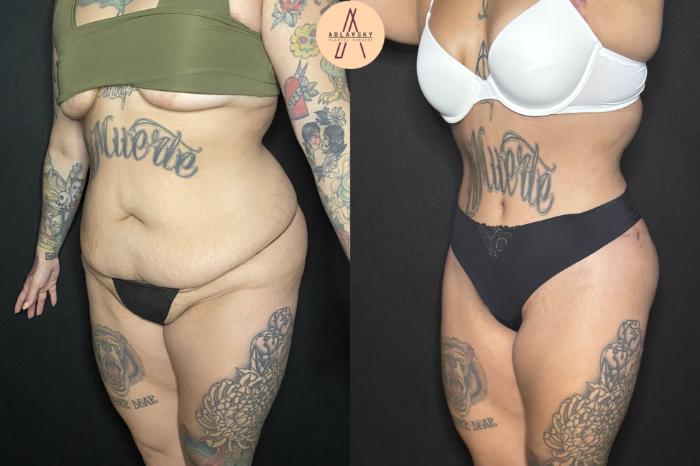 Before & After Liposuction Case 240 Left Oblique View in San Antonio, Texas