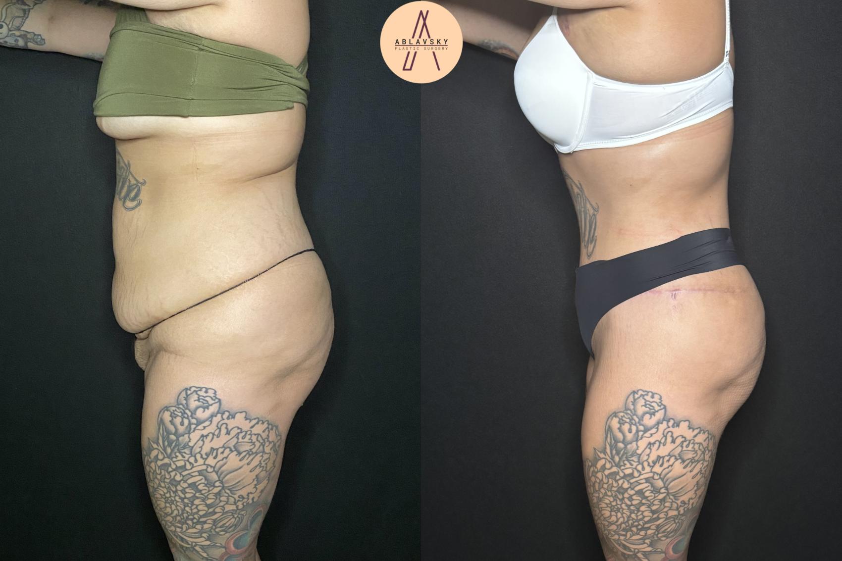 Before & After Liposuction Case 240 Left Side View in San Antonio, Texas