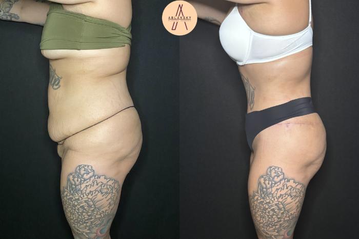 Before & After Liposuction Case 240 Left Side View in San Antonio, Texas