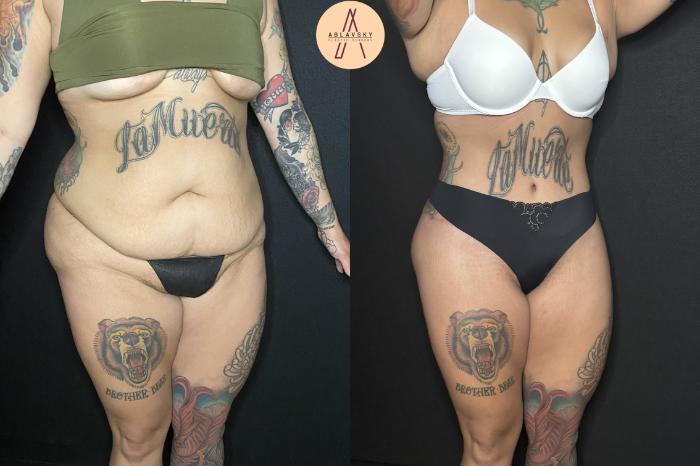 Before & After Liposuction Case 240 Right Oblique View in San Antonio, Texas