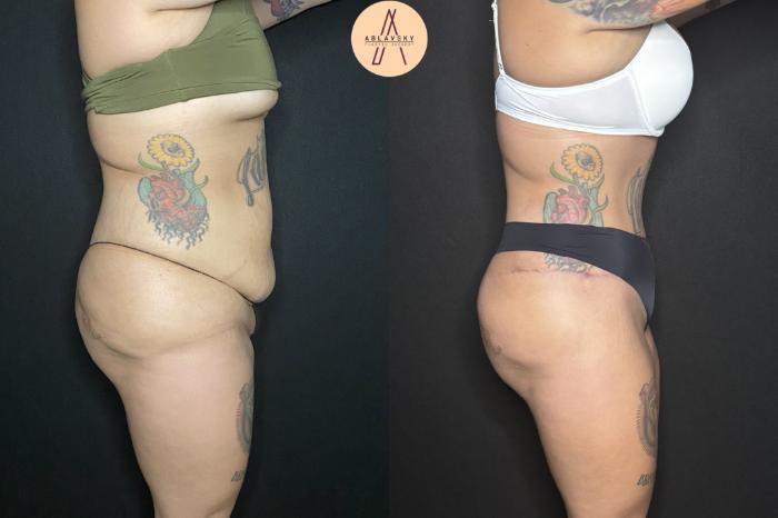 Before & After Liposuction Case 240 Right Side View in San Antonio, Texas