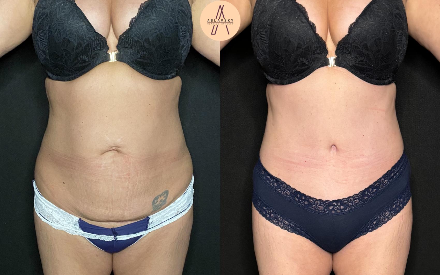 Before & After Tummy Tuck Case 241 Front View in San Antonio, Texas