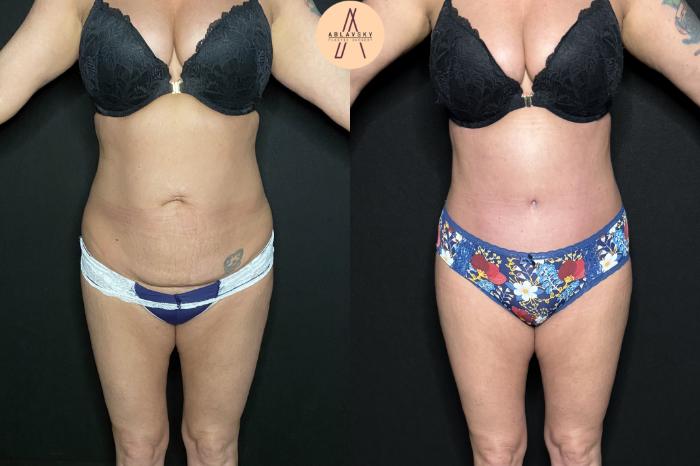 Before & After Tummy Tuck Case 241 Front View in San Antonio, Texas