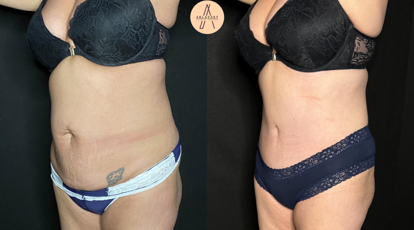 This patient wanted a leaner, tighter, more youthful abdomen. Dr. Ablavsky performed a tummy tuck with liposuction of the waistline. Call Ablavsky Plastic Surgery (210)9426672 in San Antonio to schedule a consultation. 