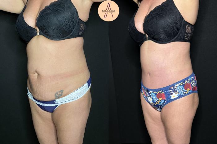 This patient wanted a leaner, tighter, more youthful abdomen. Dr. Ablavsky performed a tummy tuck with liposuction of the waistline. Call Ablavsky Plastic Surgery (210)9426672 in San Antonio to schedule a consultation. 