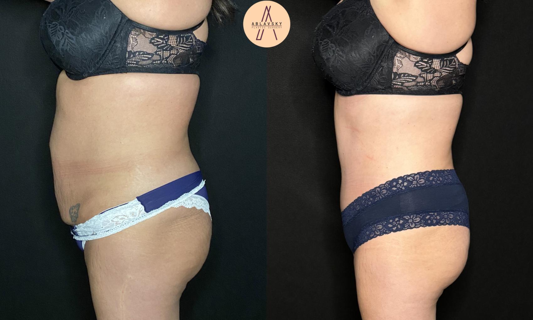 Before & After Tummy Tuck Case 241 Left Side View in San Antonio, Texas