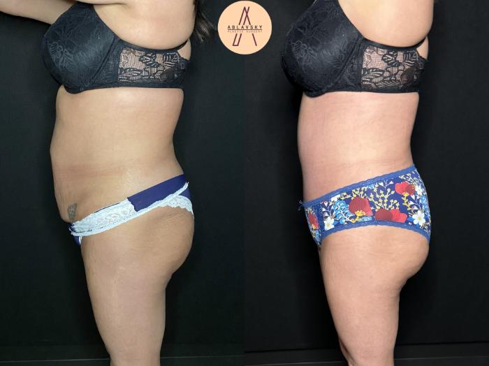 Before & After Tummy Tuck Case 241 Left Side View in San Antonio, Texas