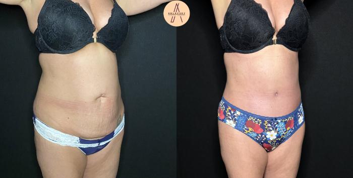 Before & After Tummy Tuck Case 241 Right Oblique View in San Antonio, Texas