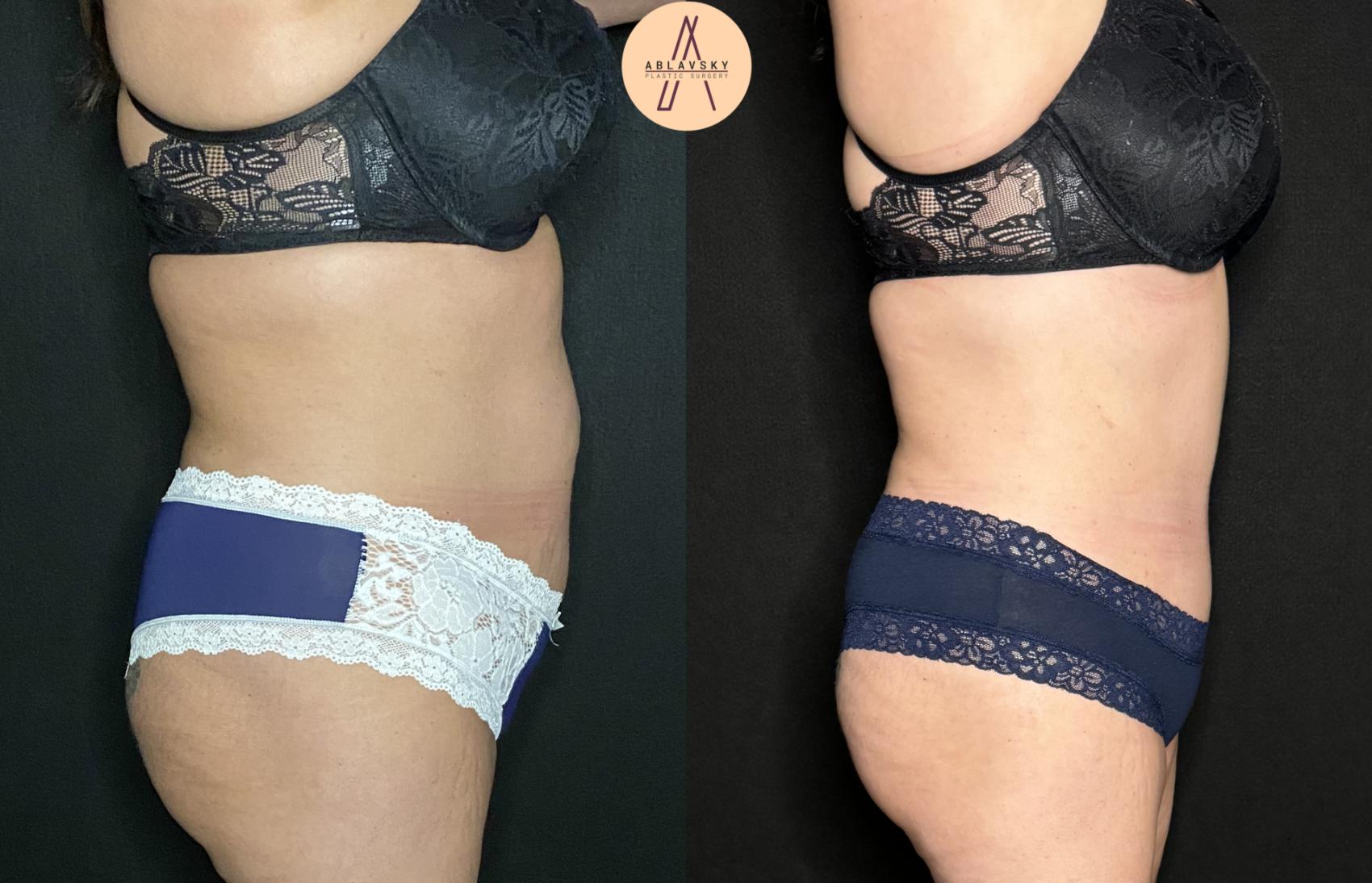 Before & After Tummy Tuck Case 241 Right Side View in San Antonio, Texas