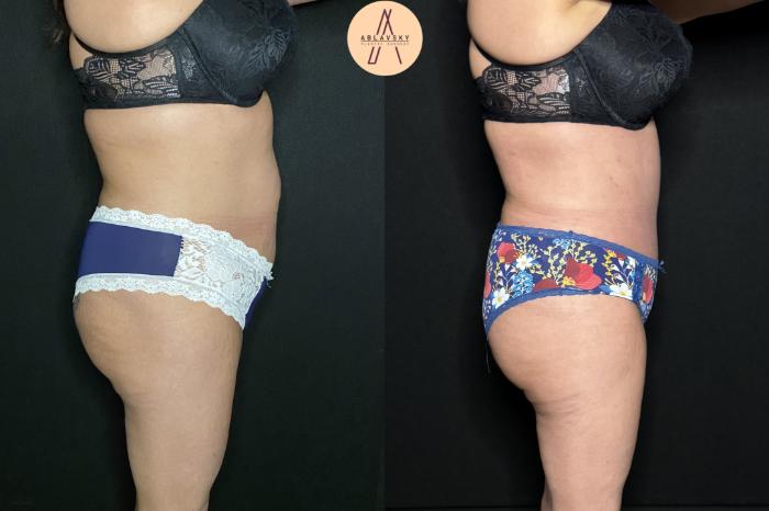 Before & After Tummy Tuck Case 241 Right Side View in San Antonio, Texas