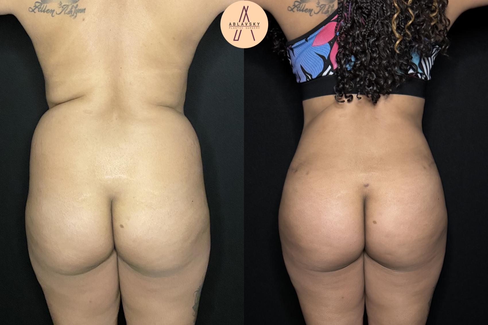 Before & After Tummy Tuck Case 243 Back View in San Antonio, Texas