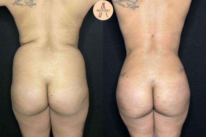 Before & After Tummy Tuck Case 243 Back View in San Antonio, Texas