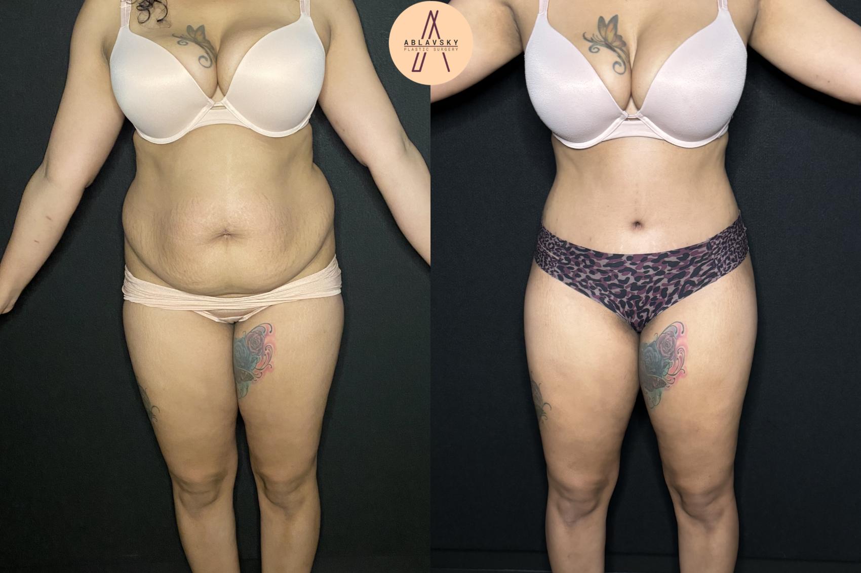 Before & After Tummy Tuck Case 243 Front View in San Antonio, Texas