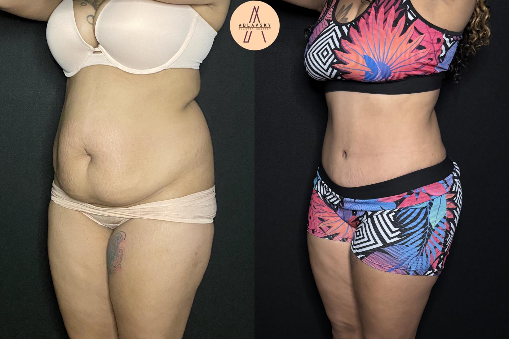 Before & After Tummy Tuck Case 243 Left Oblique View in San Antonio, Texas