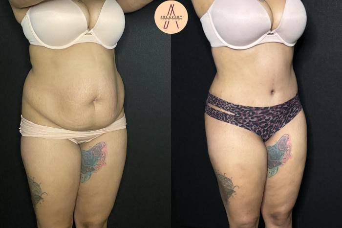 Before & After Tummy Tuck Case 243 Left Oblique View in San Antonio, Texas