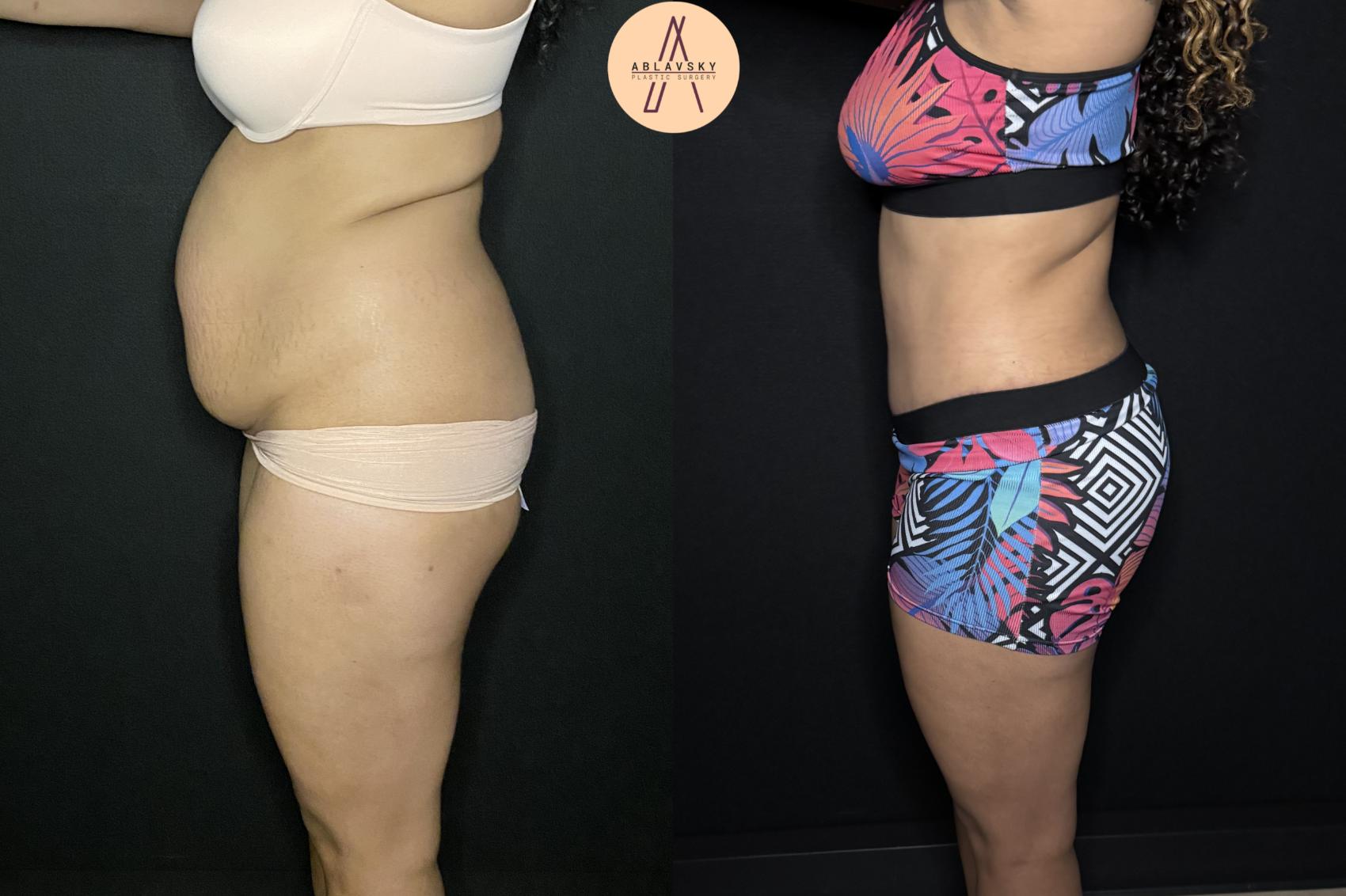 Before & After Tummy Tuck Case 243 Left Side View in San Antonio, Texas