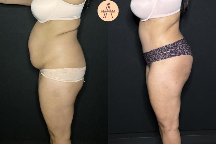 Before & After Tummy Tuck Case 243 Left Side View in San Antonio, Texas