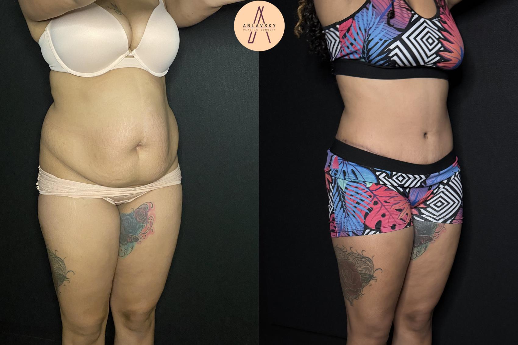 Before & After Tummy Tuck Case 243 Right Oblique View in San Antonio, Texas