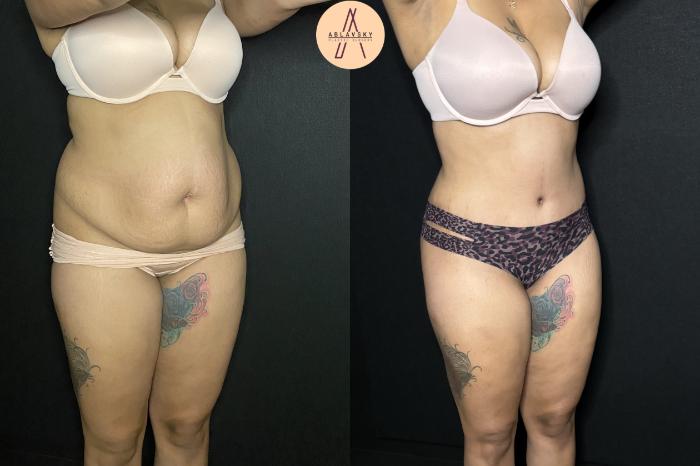 Before & After Tummy Tuck Case 243 Right Oblique View in San Antonio, Texas