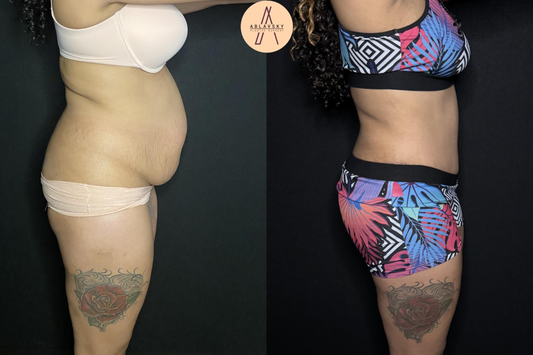 Before & After Tummy Tuck Case 243 Right Side View in San Antonio, Texas