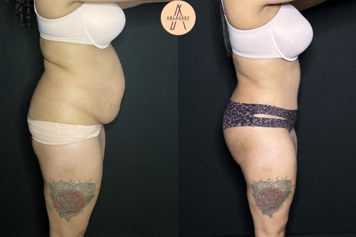 Before & After Tummy Tuck Case 243 Right Side View in San Antonio, Texas