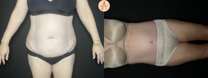 Before & After Tummy Tuck Case 245 Front View in San Antonio, Texas