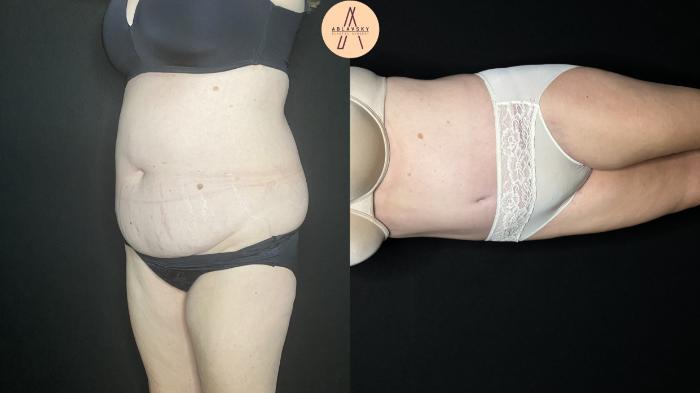 Before & After Tummy Tuck Case 245 Left Oblique View in San Antonio, Texas