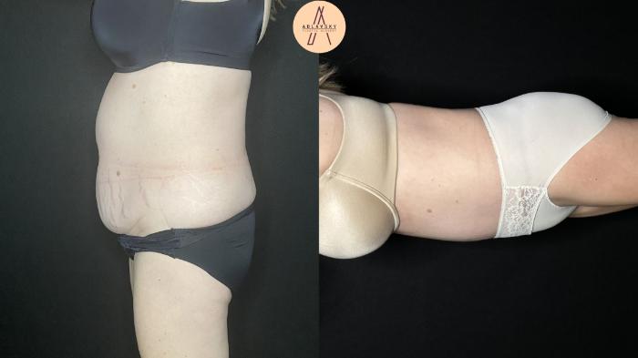 Before & After Tummy Tuck Case 245 Left Side View in San Antonio, Texas