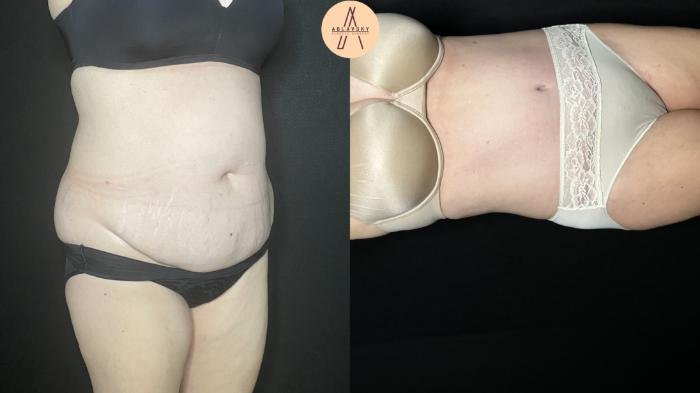 Before & After Tummy Tuck Case 245 Right Oblique View in San Antonio, Texas