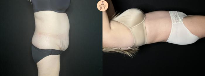 Before & After Tummy Tuck Case 245 Right Side View in San Antonio, Texas