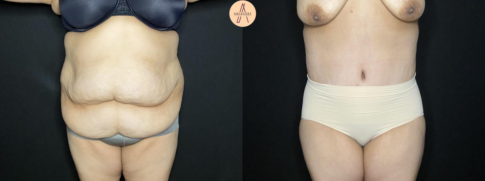 Before & After Liposuction Case 248 Front View in San Antonio, Texas