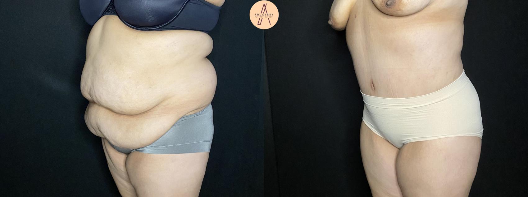 Before & After Liposuction Case 248 Left Oblique View in San Antonio, Texas