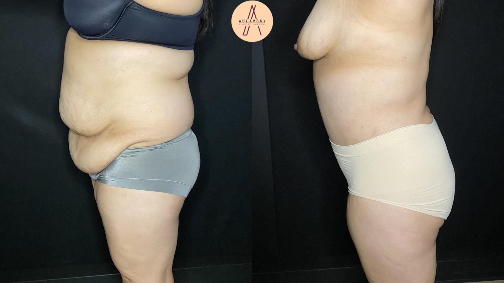 Before & After Liposuction Case 248 Left Side View in San Antonio, Texas