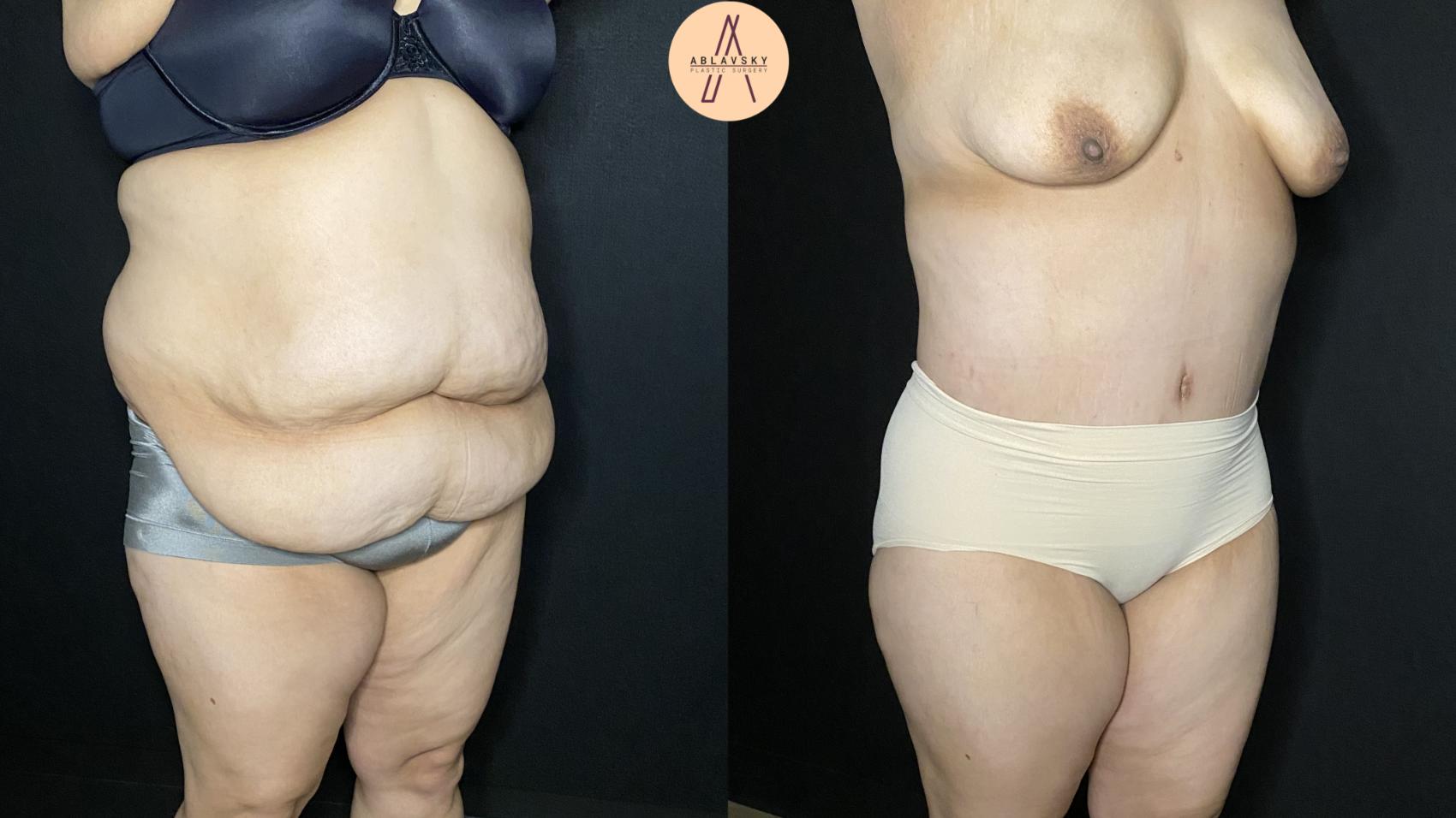 Before & After Tummy Tuck Case 248 Right Oblique View in San Antonio, Texas