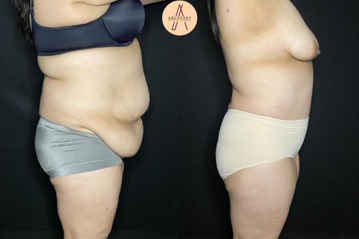 Before & After Tummy Tuck Case 248 Right Side View in San Antonio, Texas