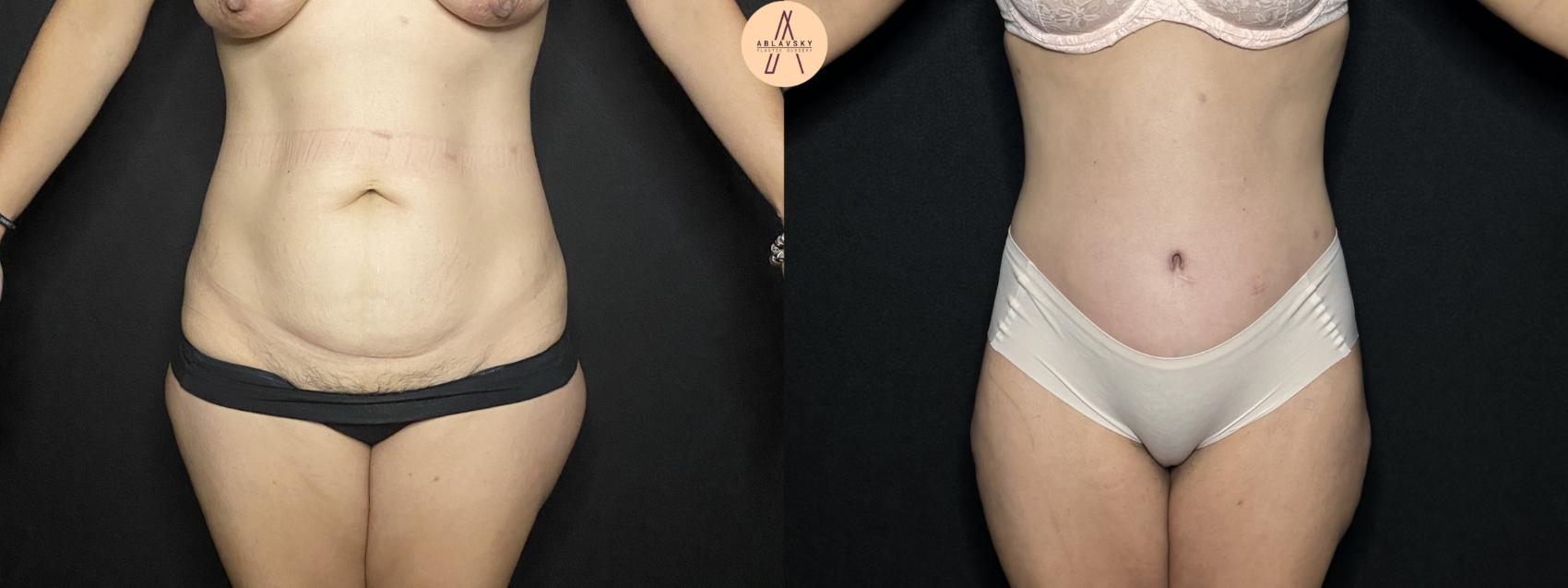 Before & After Tummy Tuck Case 254 Front View in San Antonio, Texas