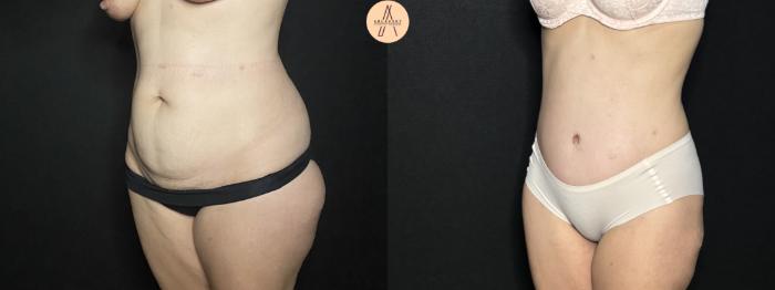 Before & After Tummy Tuck Case 254 Left Oblique View in San Antonio, Texas