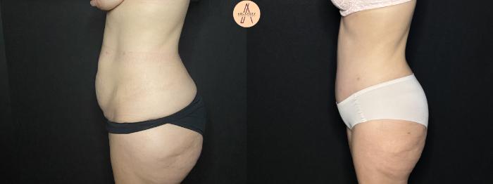 Before & After Tummy Tuck Case 254 Left Side View in San Antonio, Texas