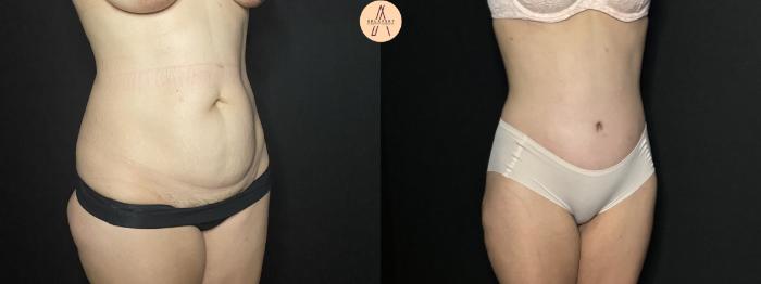 Before & After Tummy Tuck Case 254 Right Oblique View in San Antonio, Texas